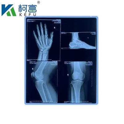 클리닉 및 병원용 맞춤형 크기의 블루 PET 기반 X선 잉크젯/ 레이저 필름 의료 이미지