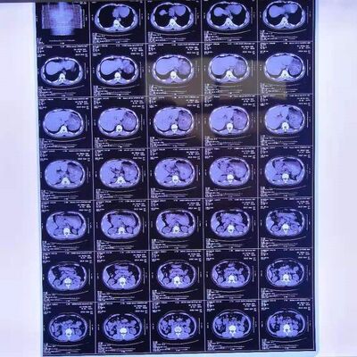 합리적인 비용의 의료용 X-ray 필름, 높은 이미지 안정성으로 선명하고 정확한 의료 진단 이미지를 제공합니다.